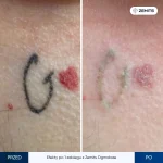 Lasere inlaturare tatoo