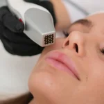 Lasere fractionate CO2